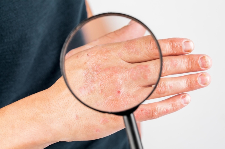 Dermatology