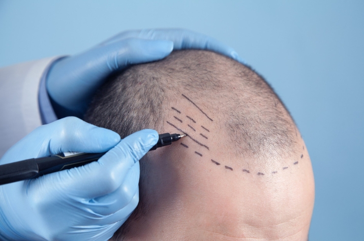 Hair Transplant Surgeries